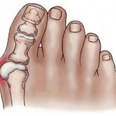 Intervento di correzione dell’alluce valgo: cosa aspettarsi nel post operatorio?